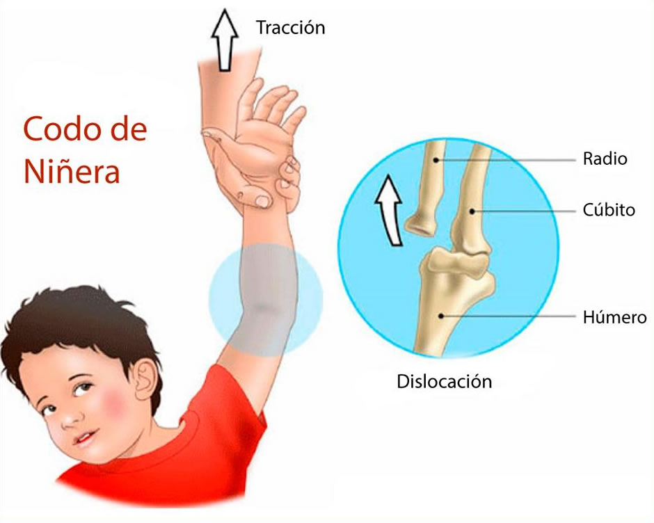 Codo de niñera (Codo dislocado)